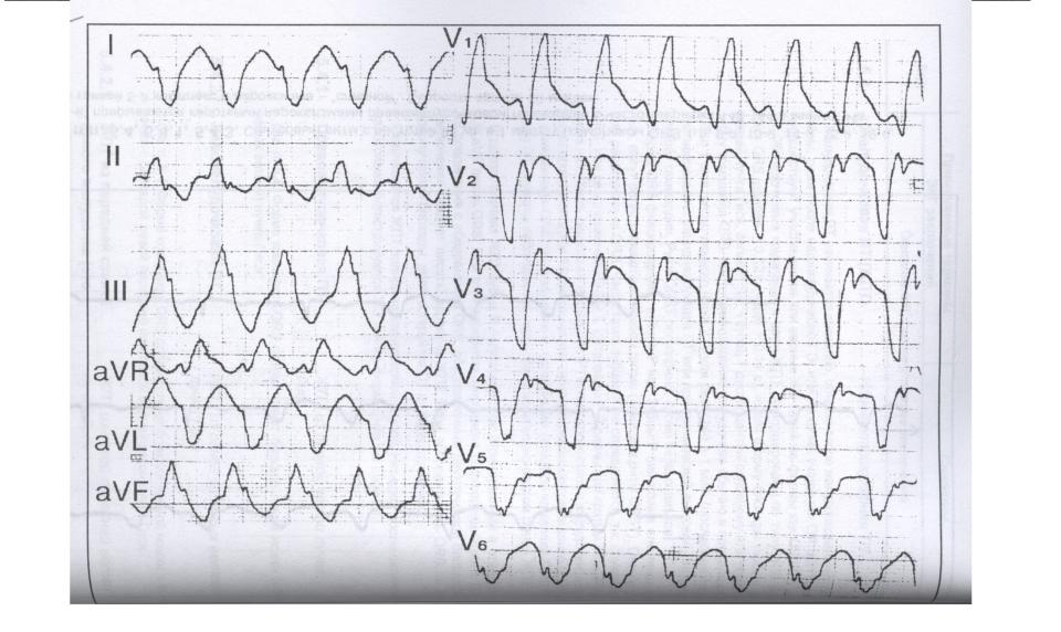 Желудочковая тахикардия экг фото