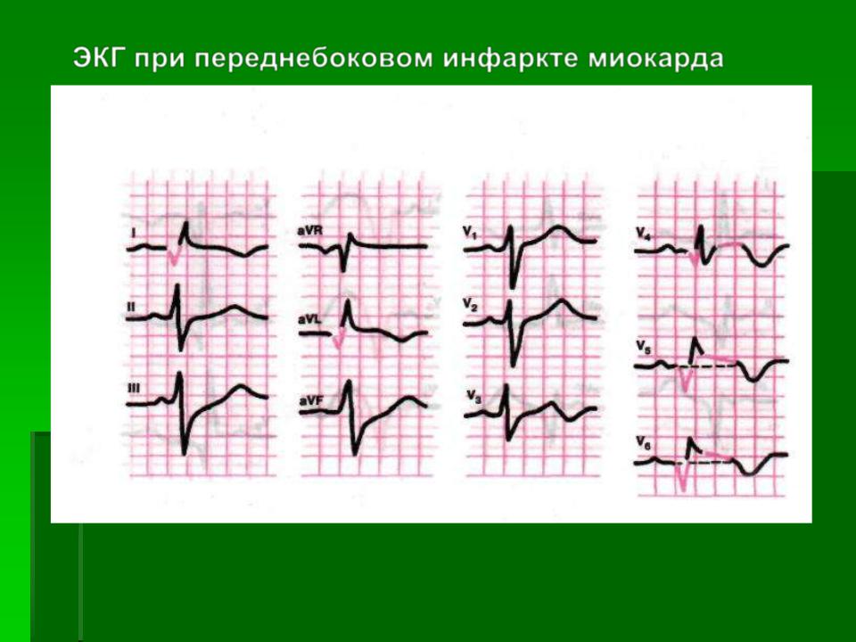 Как выглядит инфаркт на экг картинки и фото