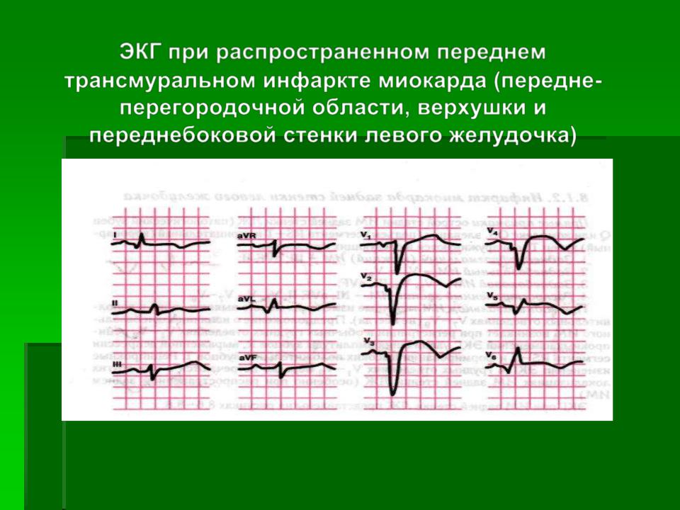 Неспецифические изменения нижней стенки. Острый распространенный передний инфаркт миокарда ЭКГ ЭКГ. Острый передне перегородочный инфаркт ЭКГ. Инфаркт миокарда трансмуральный передне перегородочный. Передний трансмуральный инфаркт миокарда ЭКГ.