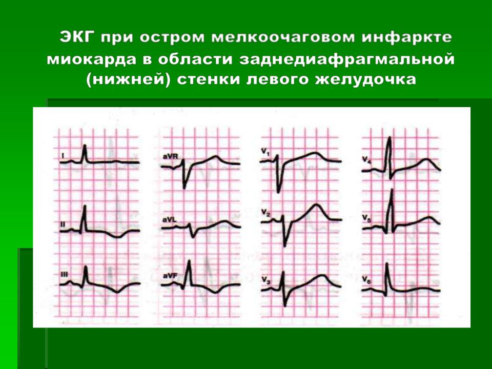 Изменение передней стенки левого желудочка. Острый инфаркт миокарда передней стенки ЭКГ. Острый инфаркт миокарда нижней стенки на ЭКГ. Мелкоочаговый Нижне-боковой инфаркт миокарда на ЭКГ. Острый боковой инфаркт миокарда ЭКГ.