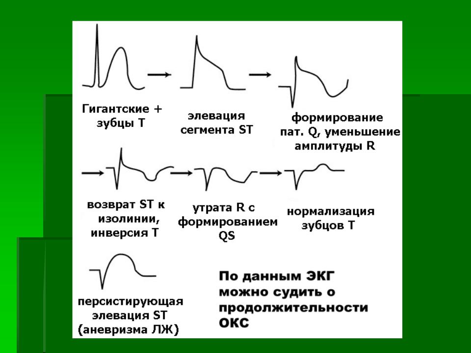 Очаговые изменения на экг. Отрицательный зубец р после QRS комплекса. ЭКГ инфаркт миокарда с подъемом St. Инфаркт миокарда ЭКГ v1 v2 v3. Сегмент St на ЭКГ В норме и патологии.
