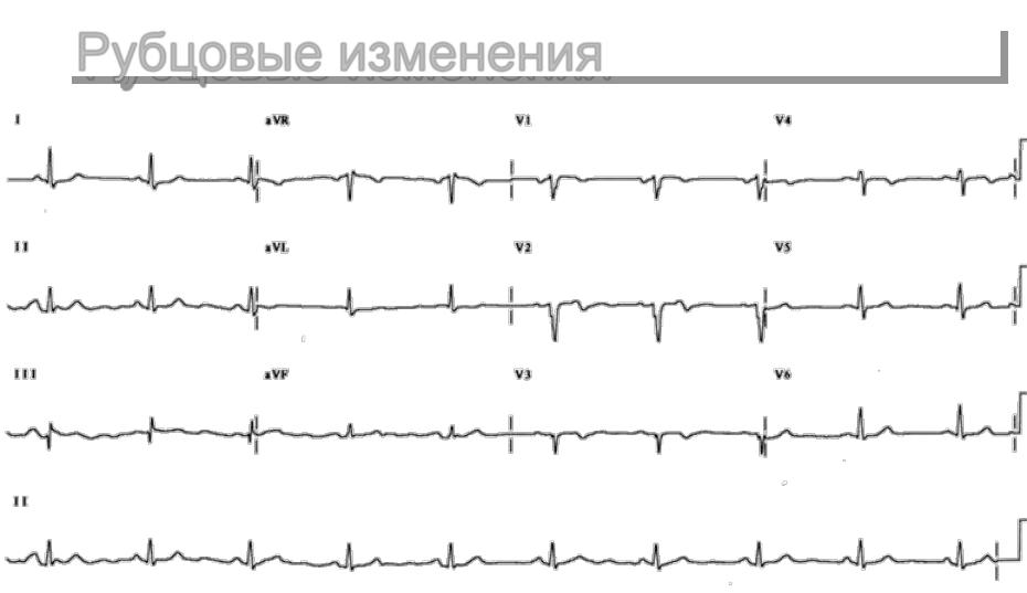 Особенности острого инфаркта миокарда и его симптомы