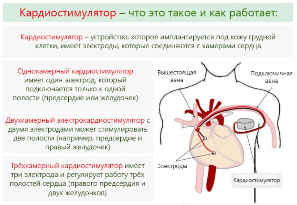 Срок службы сердца. Как работает стимулятор для сердца. Схема установки кардиостимулятора. Кардиостимулятор сердца. Виды электрокардиостимуляторов.