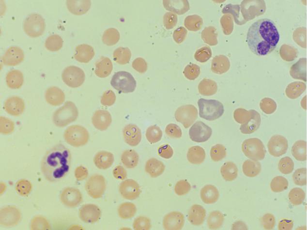 Клетки с гиперхромными ядрами. Ретикулоциты. Ретикулоциты и глисты. Агрегатные и пунктатные ретикулоциты. Ретикулоциты фото под микроскопом.