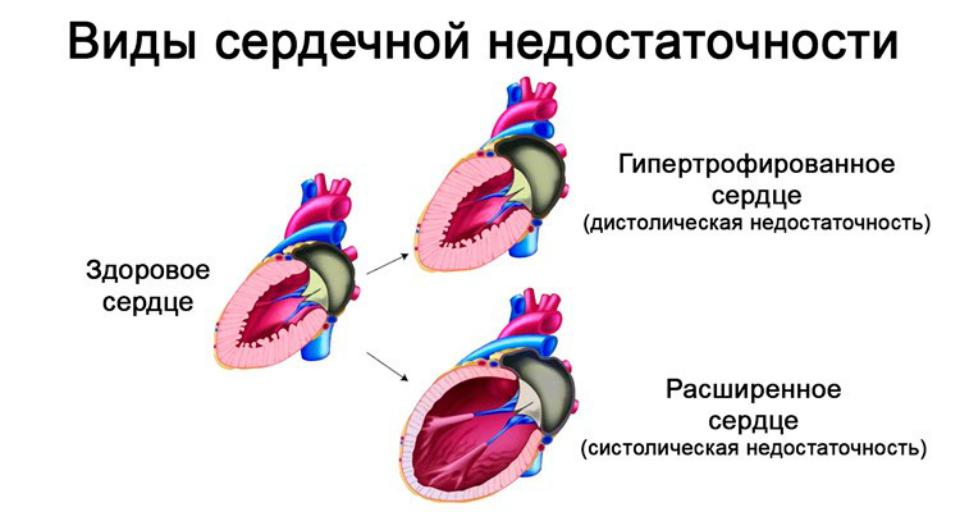 Сердечная недостаточность результат. Виды сердечной недостаточности. В ды сердечной недостаточности. Виды сердечной недоста. Сердечная недостаточность виды.