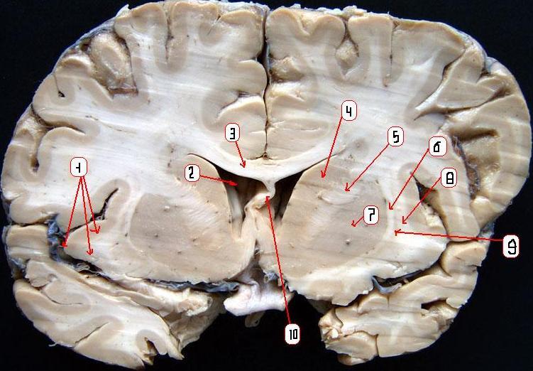 Воспаление серого вещества мозга латынь. Полосатое тело мозга. Негроидное тело в мозге. Полосатое тело фото. Полосатое тело мозга фото.