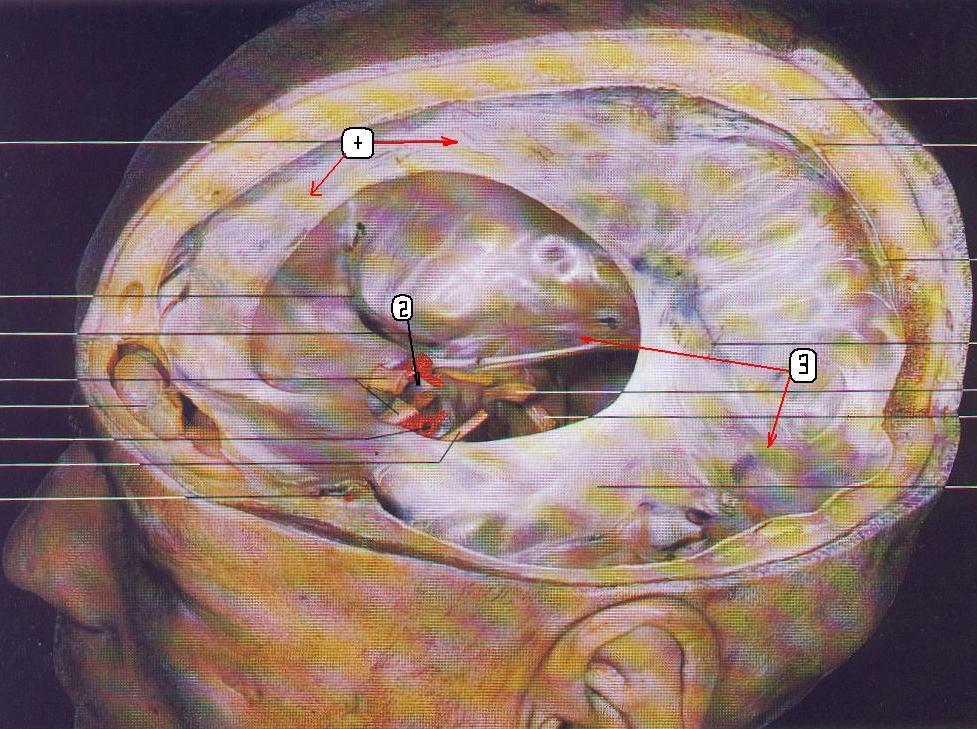 Серп большого мозга. Выросты твердой мозговой оболочки. Отростки твердой оболочки мозга. Синусы твердой мозговой оболочки намет мозжечка. Твердая мозговая оболочка анатомия.