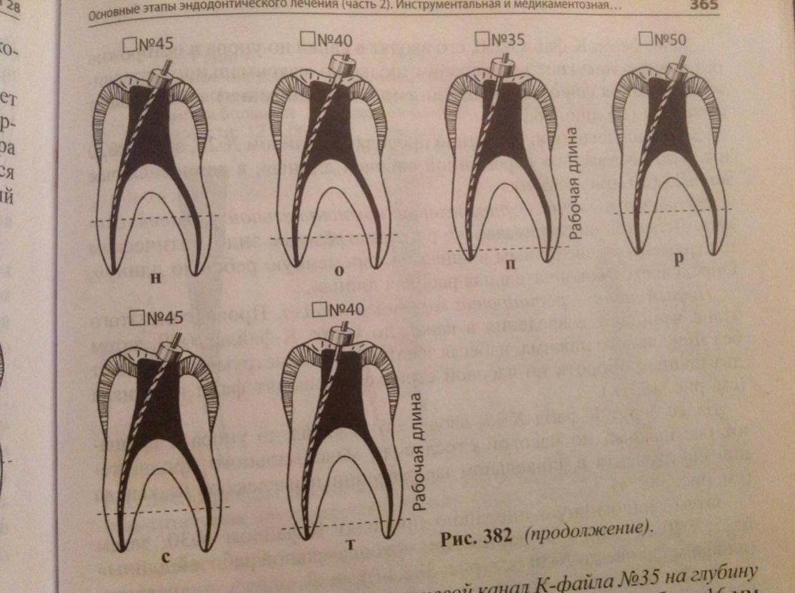 После эндодонтического лечения. Этапы эндодонтической обработки корневых каналов при периодонтите.. Этапы обработки канала зуба. Этапы эндодонтического лечения зуба. Осложнения в эндодонтии.