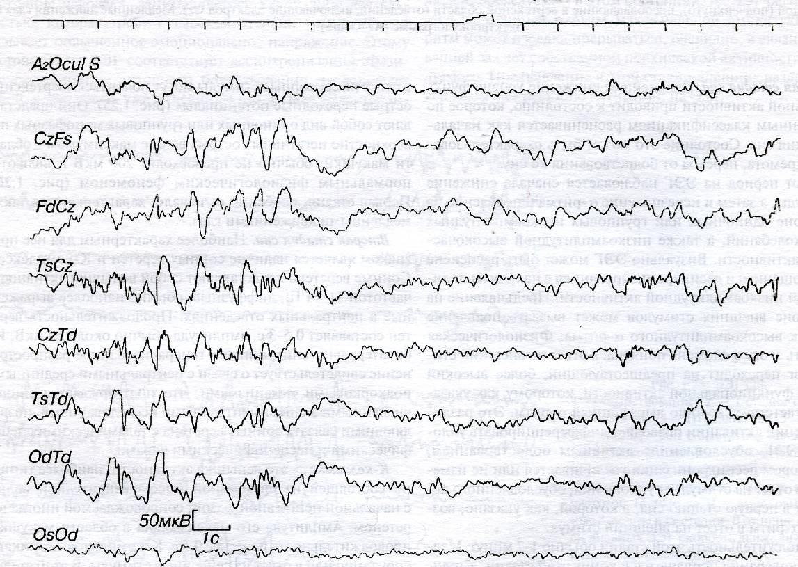 Ээг видеомониторинг сна. Электроэнцефалограмма фаз сна. Фазы сна на ЭЭГ. Медленные волны на ЭЭГ. ЭЭГ мониторинг сна.