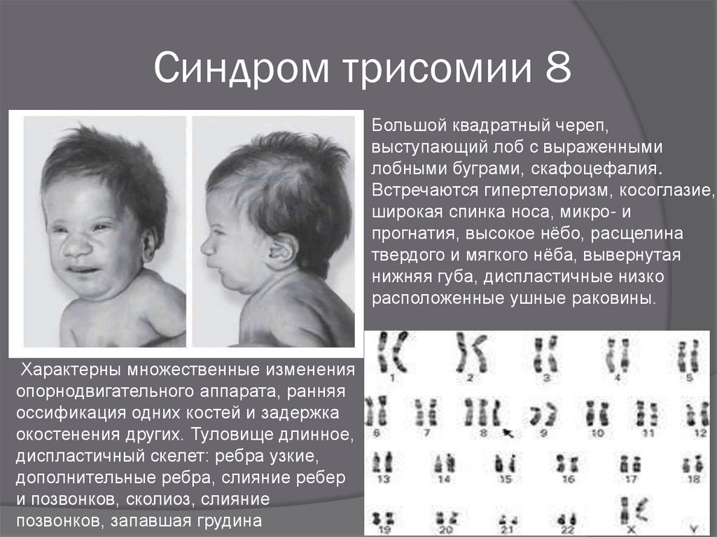 5 заболеваний хромосом. Синдром Эдвардса (трисомия по 18 паре хромосом). Хромосомные аномалии (синдром Патау, трисомия 13. Синдром Патау трисомия по 13 хромосоме. Синдром Дауна (трисомия по 21-Ой хромосоме);.