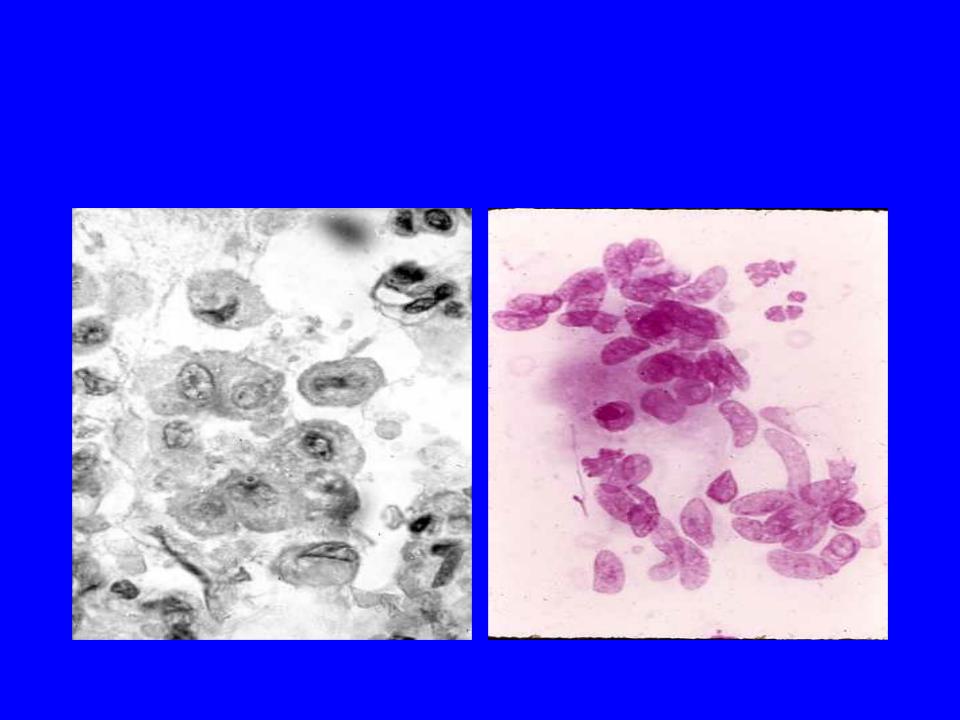 Макрофаги в молочной. Эпителиоидные макрофаги цитология. Эпителиоидная гранулема. Эпителиоидные клетки в мокроте. Эпителиоидные клетки гранулемы.