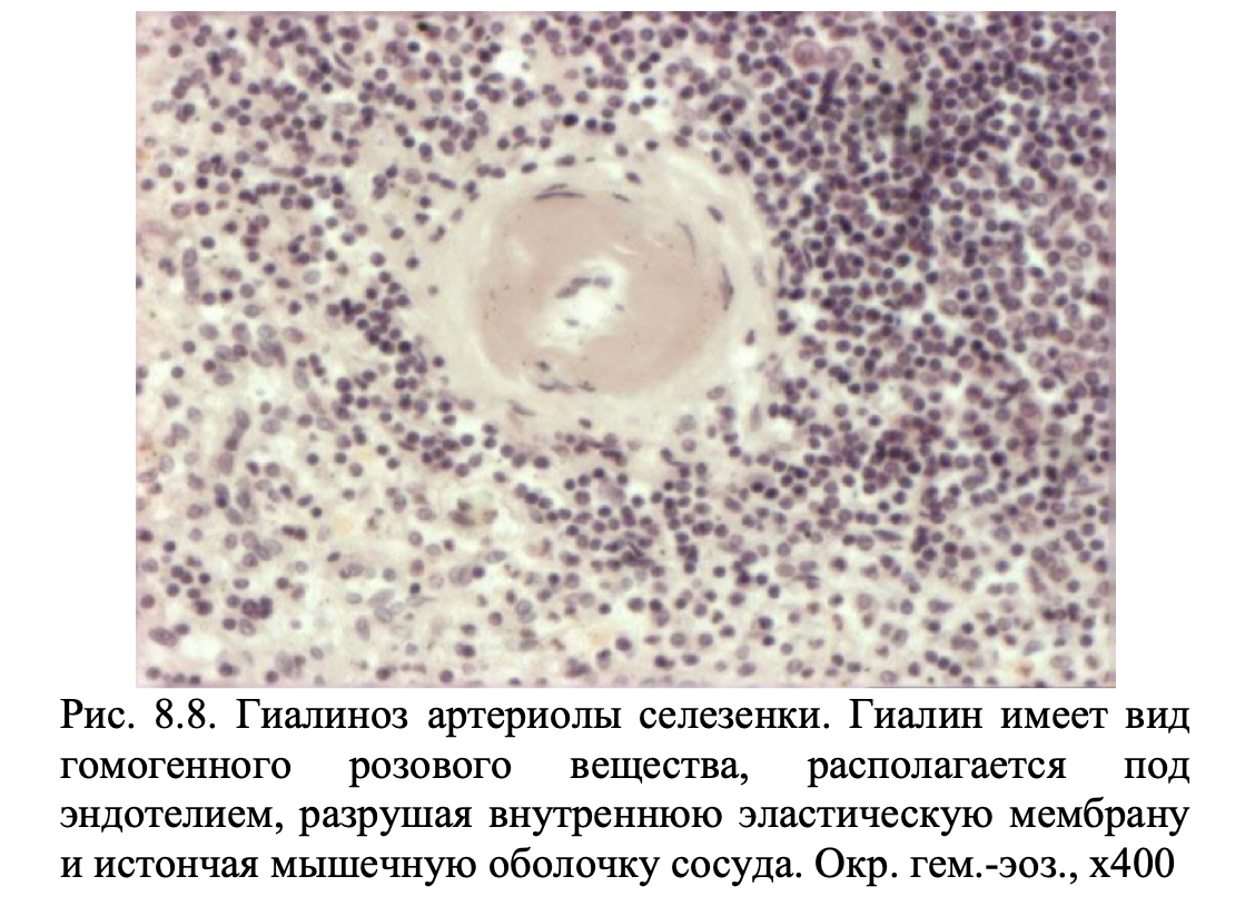 Гиалиноз относится к