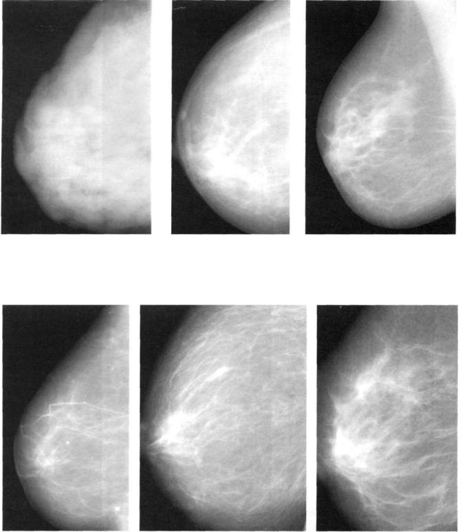 Маммограмма молочных желез норма. Диффузный фиброаденоматоз. Фиброаденоматоз bi