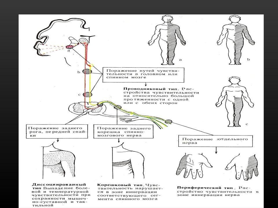 Диссоциированная чувствительность. Проводниковый Тип нарушения чувствительности. Типы нарушения чувствительности в зависимости от уровня поражения. Периферический полиневритический Тип нарушения чувствительности. Типы расстройств чувствительности неврология.