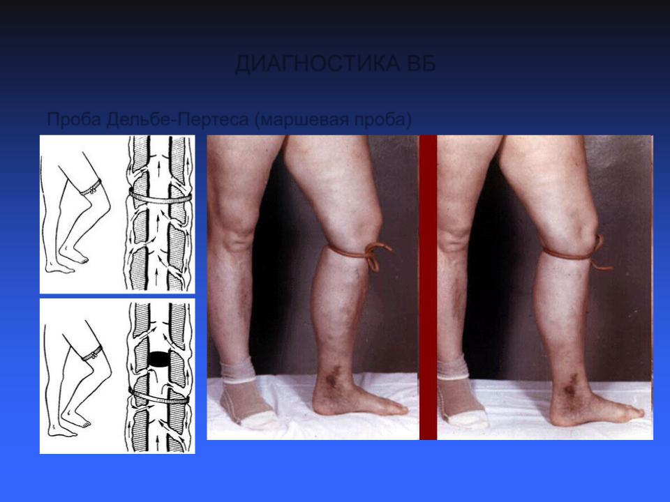 TENS kezelés a gyakorlatban A bokaízület 1. fokozatának artrózisának kezelése