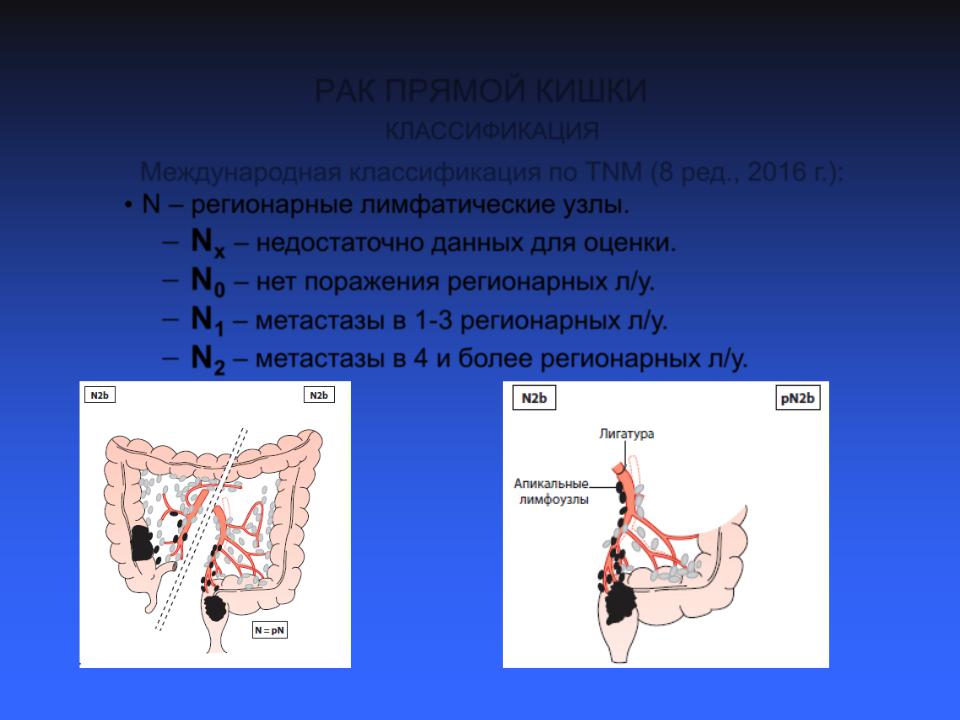 Рак кишечника метастазы прогноз. TNM прямой кишки.
