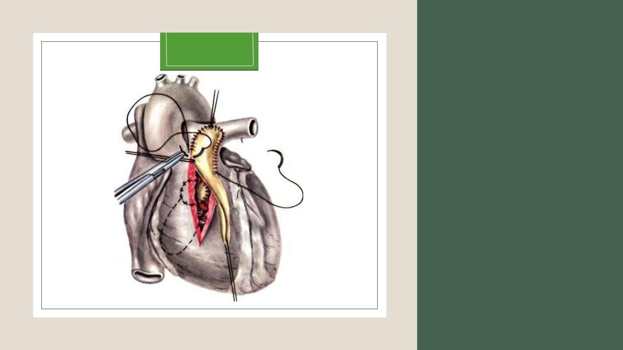Операция рча отзывы пациентов. Радиочастотная катетерная абляция сердца.