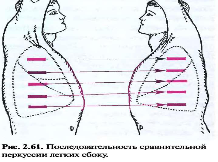 Сравнительная перкуссия. Сравнительная перкуссия легких сбоку. Перкуссия по боковой поверхности грудной клетки 10 точек. Сравнительная перкуссия легких в боковых отделах. Последовательность сравнительной перкуссии легких.