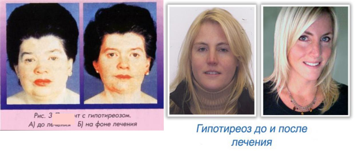 Кожа при гипотиреозе. Гипотиреоз фото женщин до и после. Фото людей СГИПОТЕРИОЗОМ. Внешность людей с гипотиреозом.