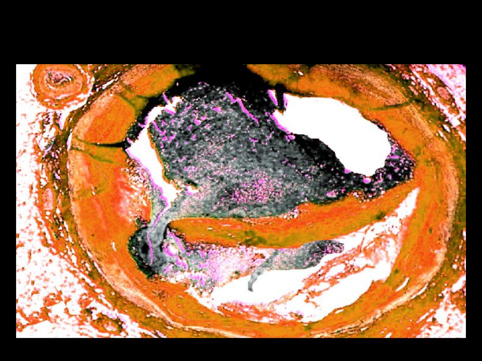 Тромб и бляшка разница. Тромбоз атеросклеротической бляшки. Атеросклеротическая бляшка с обтурирующим тромбом. Тромб и атеросклеротическая бляшка разница. Атеросклеротическая бляшка с обтурирующим тромбом микропрепарат.