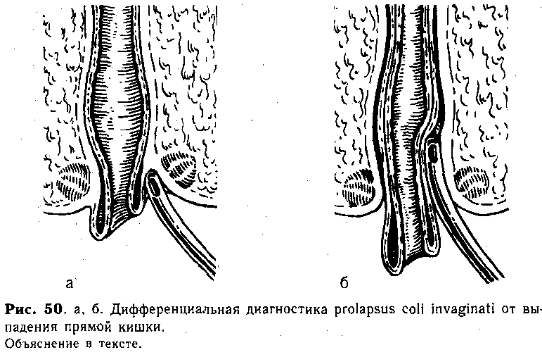 Выпадение кишки операция. Выпадение прямой кишки и инвагинация. Интраректальная инвагинация прямой кишки. Инвагинация стенки прямой кишки. Выпадение прямой кишки дифференциальная диагностика.