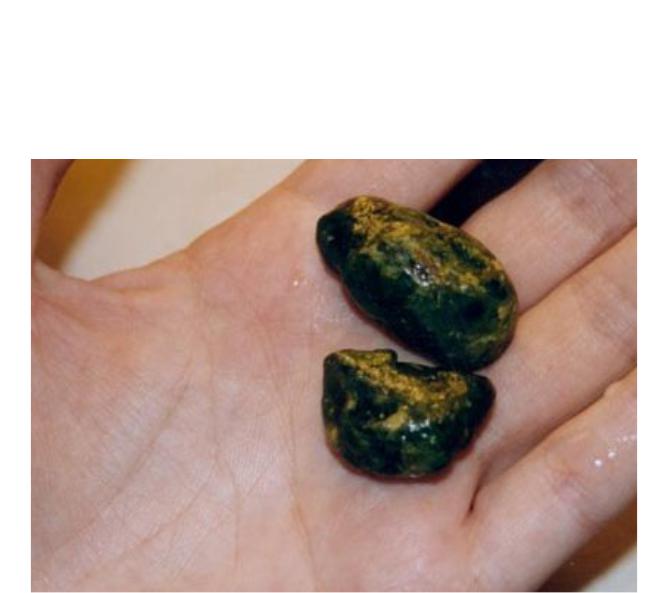 Камни желчном спб. Билирубиновые камни в желчном пузыре причина образования. Камень в жёлчном пузыре 1см. 48мм камень в желчном пузыре. Показать 15мм камень в желчном пузыре.