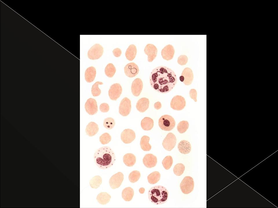 Анемия 2024. Кровь при в12 дефицитной анемии. Б12 дефицитная анемия картина крови. Картина крови при в12 дефицитной.