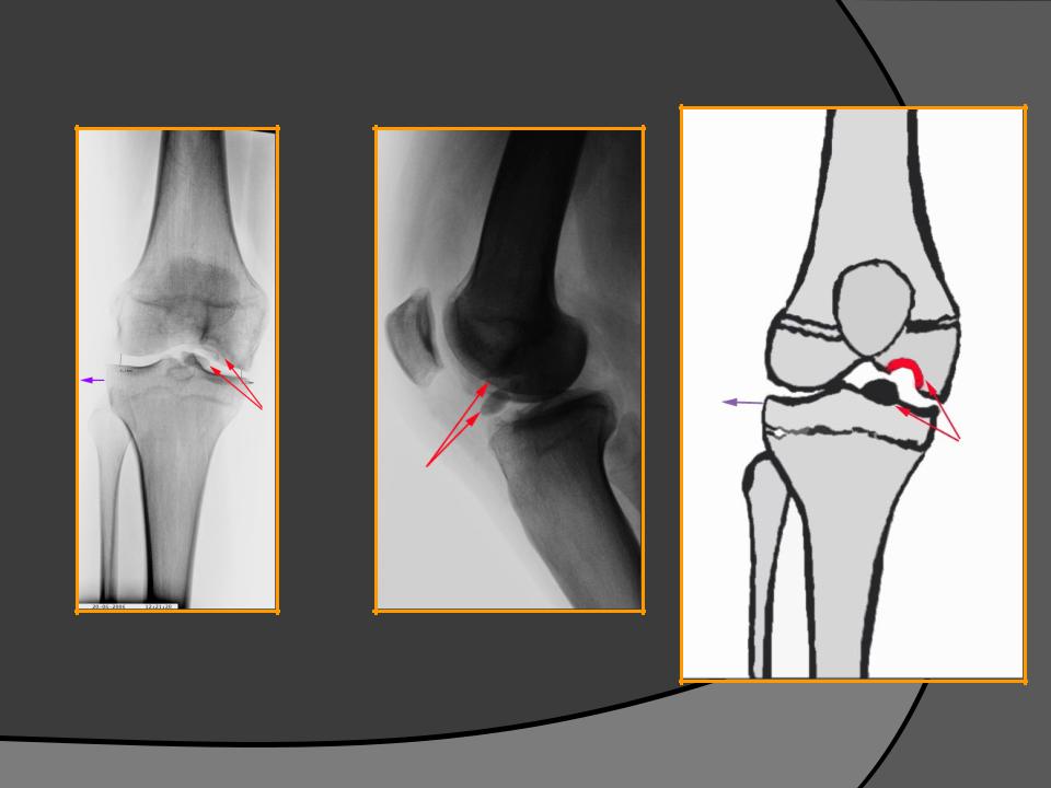 Асептический некроз мыщелков. Асептический некроз мыщелка бедра. Остеонекроз коленного сустава рентген. Некроз коленного сустава (остеонекроз). Остеонекроз тазобедренного сустава.