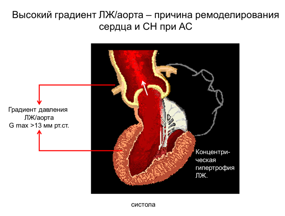 I. Стеноз устья аорты