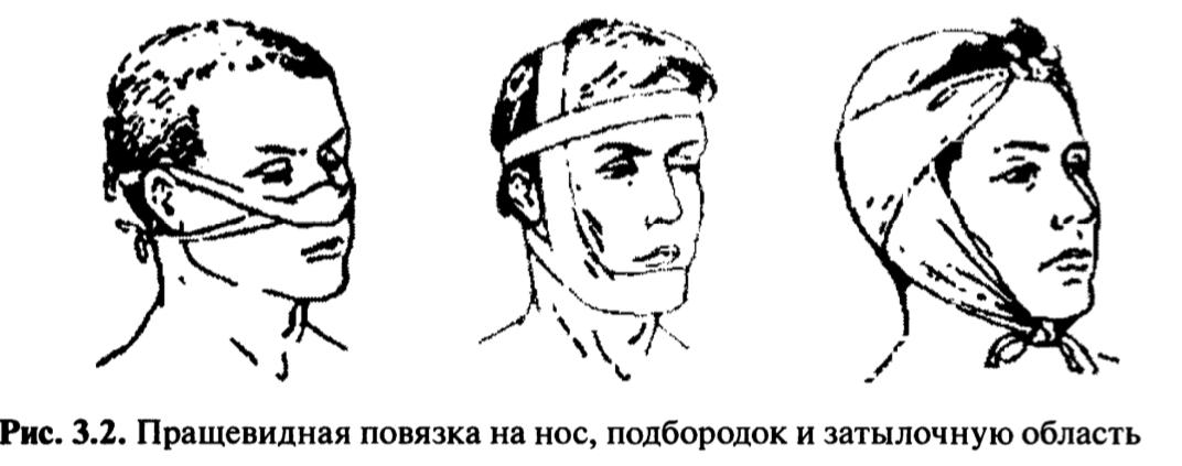 Техника наложения пращевидной повязки. Пращевидная повязка алгоритм. Десмургия пращевидная повязка. Наложение пращевидной повязки алгоритм.