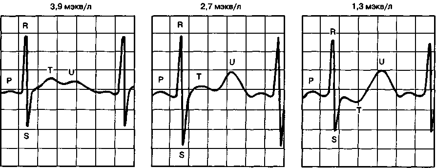 Гипокалиемия на экг картинки