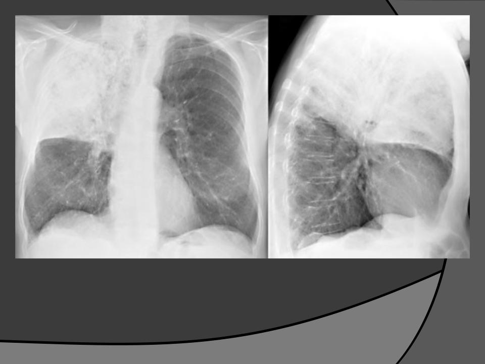 Пневмония верхней доли легкого. Шаровидная абсцедирующая пневмония. Пневмония верхней доли правого легкого рентген. Пневмония средней доли правого легкого рентген. Плеврит и пневмония рентген.