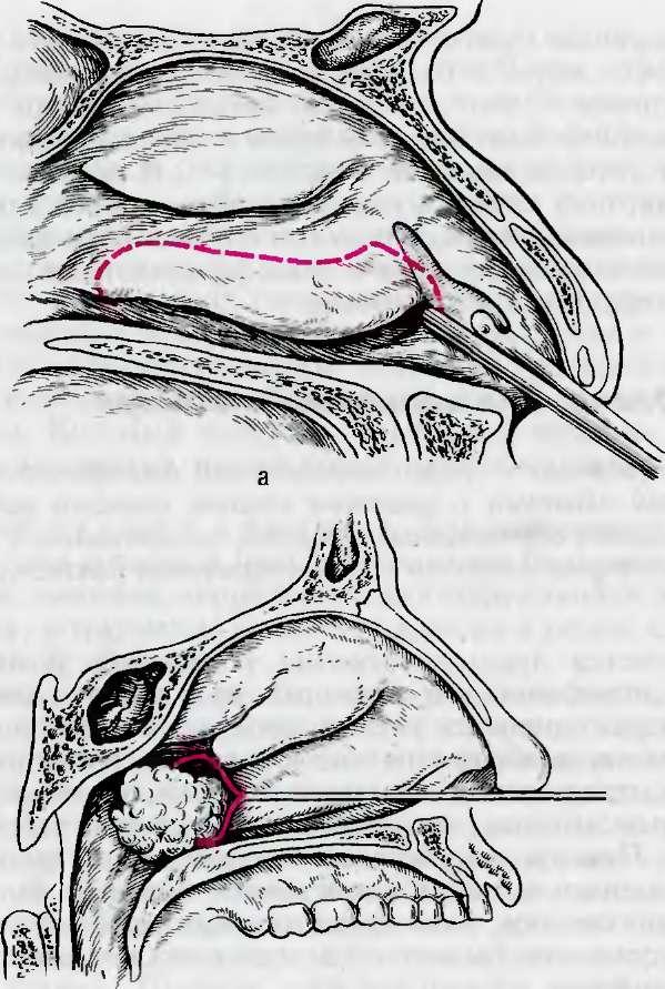 Подслизистая вазотомия носовых. Шейверная конхотомия носовых. Вазомоторный ринит операция. Щадящая нижняя конхотомия.