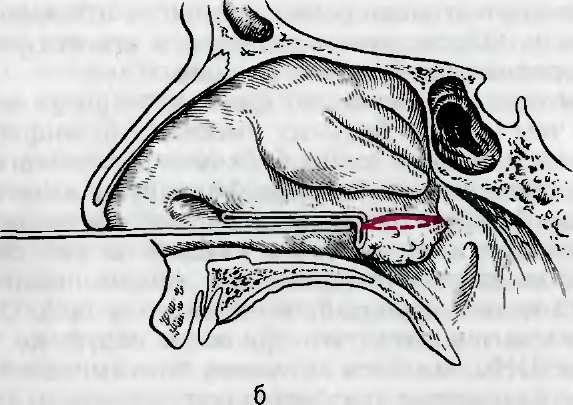 Нижняя подслизистая вазотомия. Вазотомия носовых раковин. Нижние носовые раковины гипертрофированы. Шейверная конхотомия носовых. Конхотомия нижних носовых раковин.