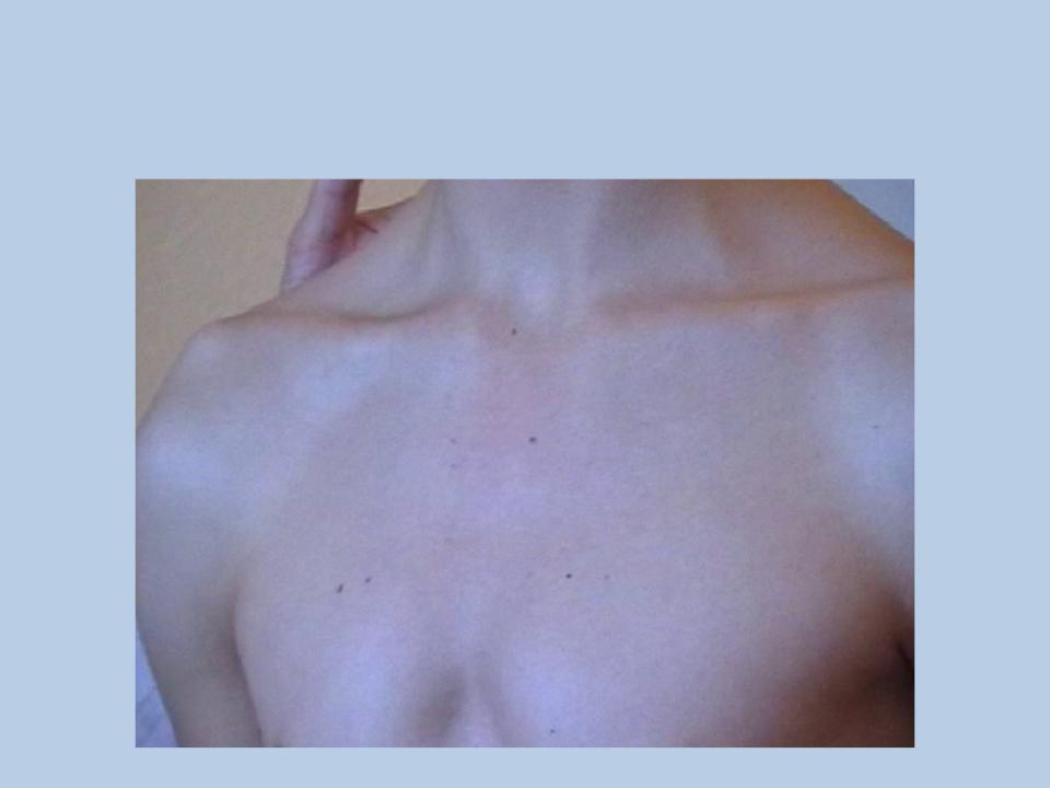 Лимфоузлы грудной клетки расположение у женщин фото