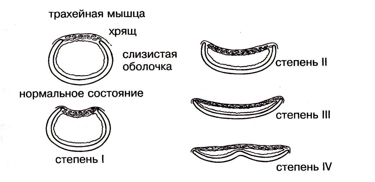 7.2 Коллапс трахеи (collapsus tracheae)
