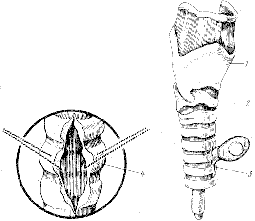 6.7 Отек гортани (oedema laryngis)