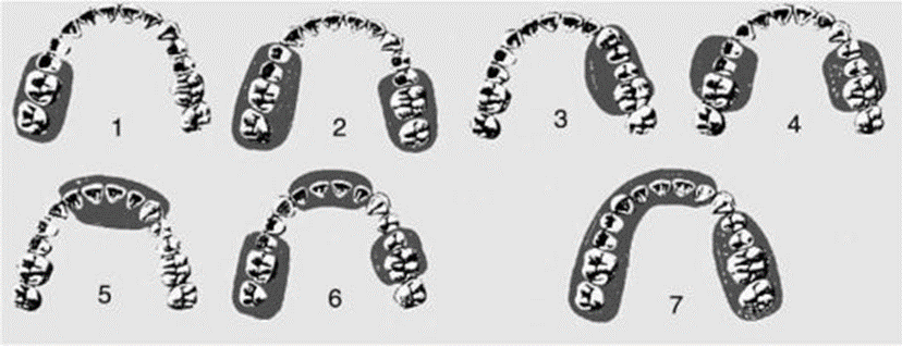 Зубные дефекты по кеннеди. Классификация дефектов зубных рядов по Кеннеди Гаврилову Бетельману. Классификация зубных рядов по Кеннеди и Гаврилову. Классификация дефектов зубных рядов по Кеннеди.