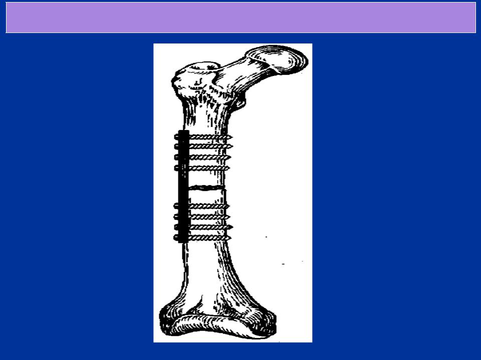 Операции на костях. Экстрамедуллярный остеосинтез. Внеочаговый экстрамедуллярный остеосинтез. Экстрамедуллярный остеосинтез животных. Интра и экстрамедуллярный остеосинтез.