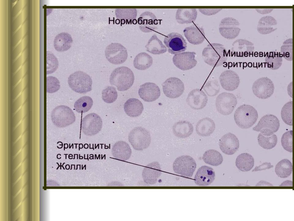 Презентация по серповидноклеточной анемии