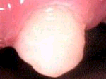 Атравматичного восстановительного лечения кариеса зубов thumbnail