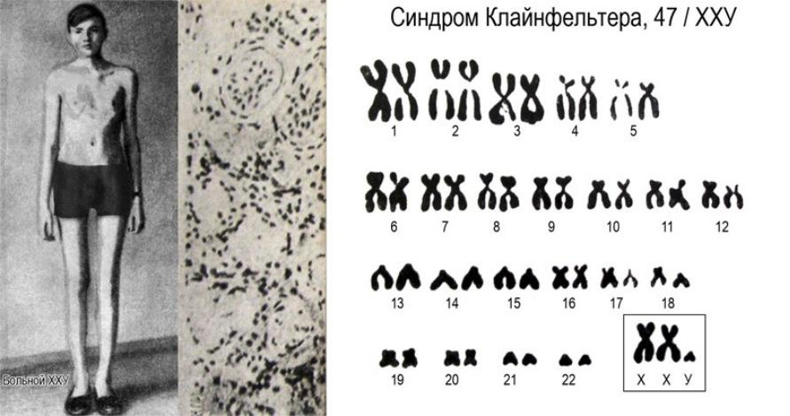 Х хромосома это мужская. Xxy синдром Клайнфельтера кариотип 47. Генотип человека с синдромом Клайнфельтера. Синдром Клайнфельтера хромосомы. Синдром Клайнфельтера 47 xxy.
