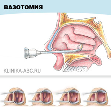 Нижняя подслизистая вазотомия