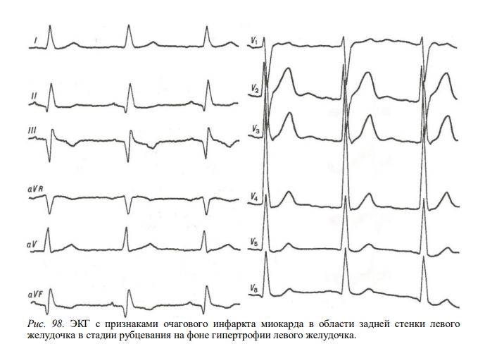 Ишемия нижней стенки на экг