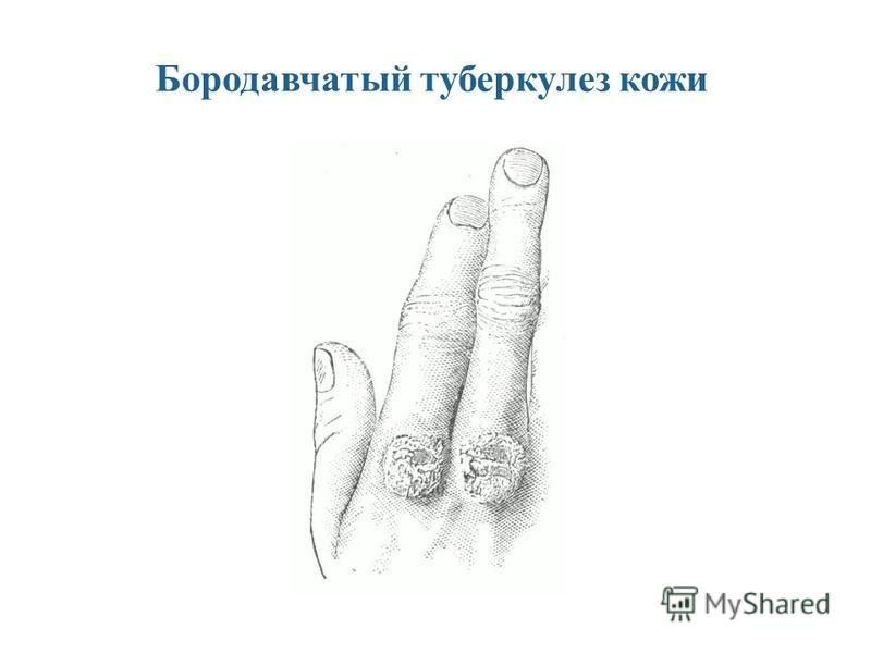 Как выглядит туберкулез кожи
