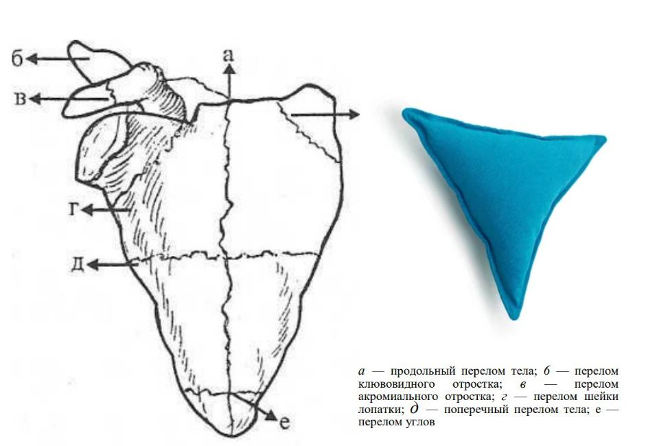 Переломы лопатки