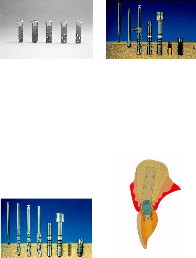 15. The ITI Dental Implant System 15. The ITI Dental Implant System